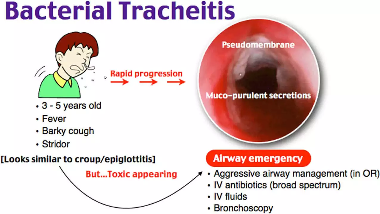 How azithromycin can help treat tracheitis