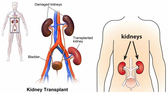 Organ Rejection: A Patient's Perspective on the Transplant Experience