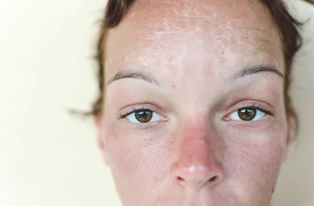Sunburn and Rosacea: Managing Flare-Ups and Protecting Your Skin